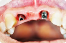 多数牙缺失修复案例