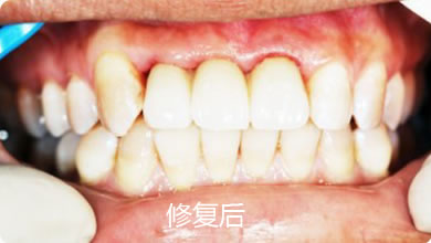 多数牙缺失修复案例3